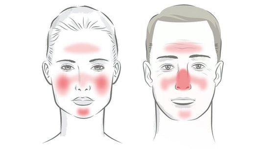 Rosacea: causes and treatments
