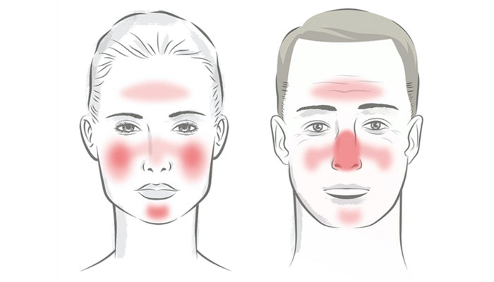 Rosacea: causes and treatments